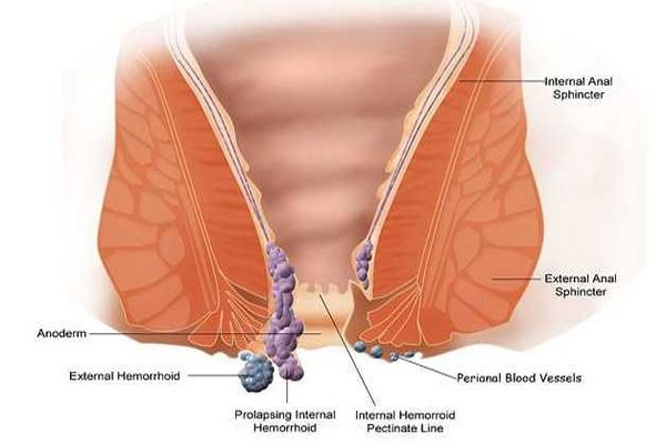 Piles Treatment In Jammu