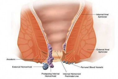 Piles Treatment In Jammu And Kashmir